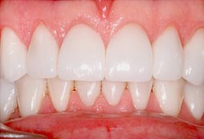 Avanti Dental Care | Dental Bridges, Cosmetic Dentistry and Crowns amp Caps