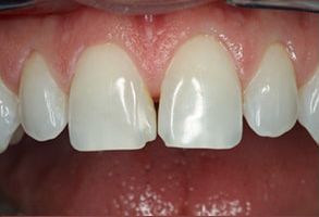 Avanti Dental Care | Root Canals, Dental Cleanings and Teeth Whitening
